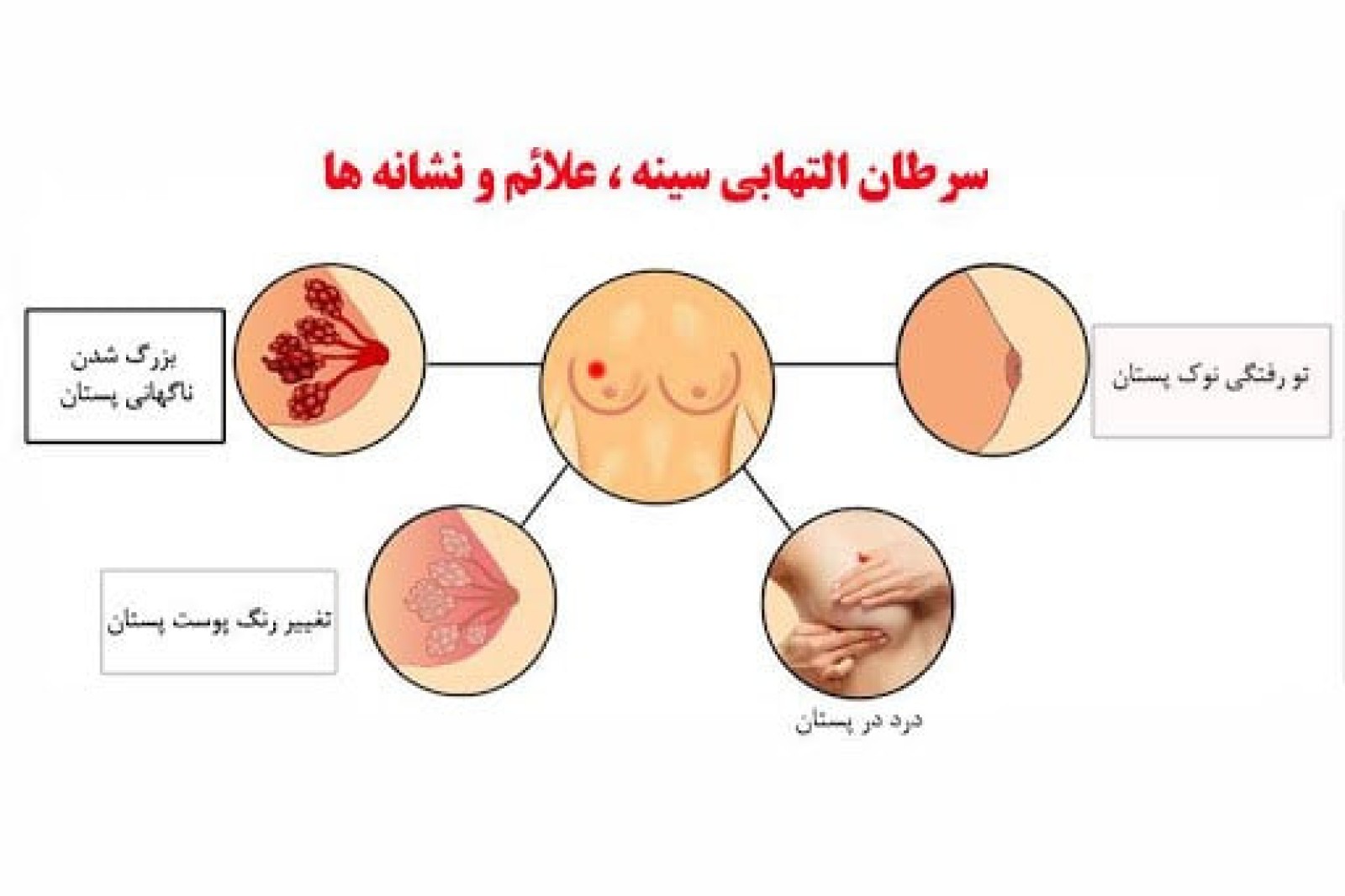 سرطان سینه چه نشانه ها و علائمی