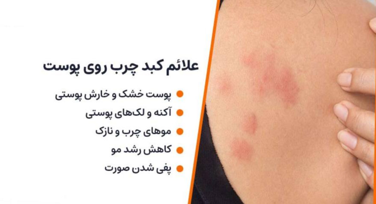 علائم کبد چرب در پوست صورت